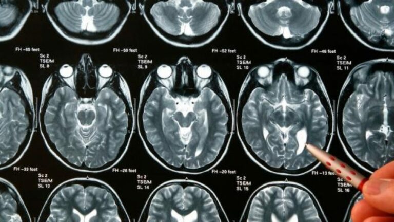 tumor cerebral